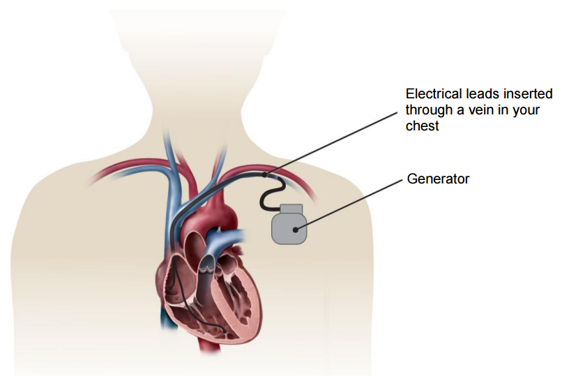 how is a pacemaker attached to the heart