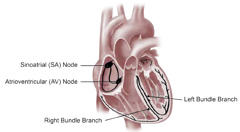 Medical illustration of a heart showing the sinoatrial node, the atrioventricular node, and the left and right bundle branches, which control the electrical impulse that causes your heart to pump.