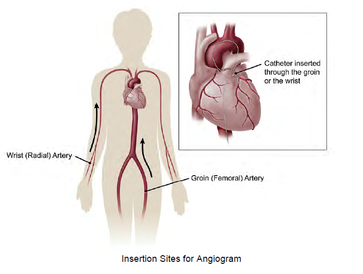 Medical illustration of a heart showing the path for an angiogram catheter to the heart, after being inserted through the radial artery in the wrist or femoral artery in the groin.