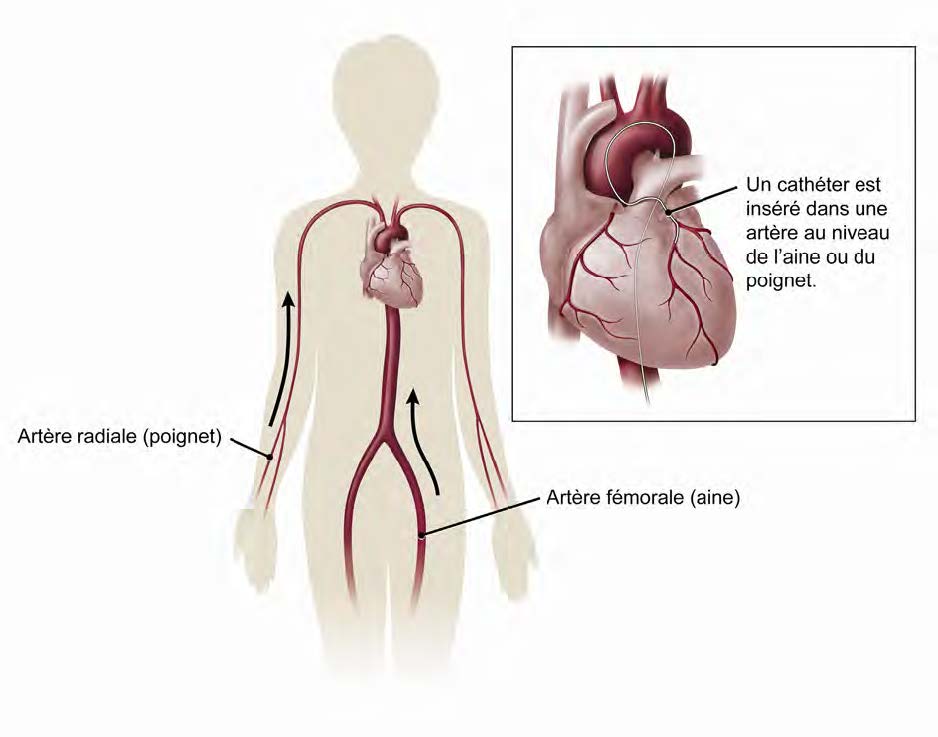 Image montrant comment un cathéter est inséré dans l'artère radiale à partir du bras ou dans l'artère fémorale à partir de l'aine, et dirigée vers le cœur dans le cadre d'une angiographie