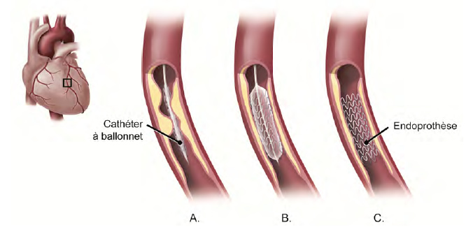 Insertion d'une endoprothèse : A. Le cathéter à ballonnet et l'endoprothèse fermée sont insérées dans l'artère. B. Le ballonnet est gonflé, ce qui déploie l'endoprothèse. C. Le cathéter est retiré, mais l'endoprothèse demeure contre la paroi artérielle