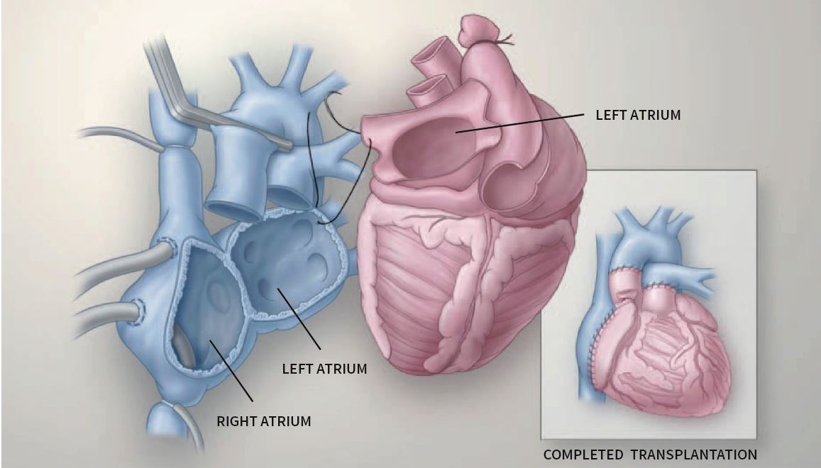 Medical illustration showing the connection of the patient atria with the donor heart in a biatrial heart transplant procedure.
