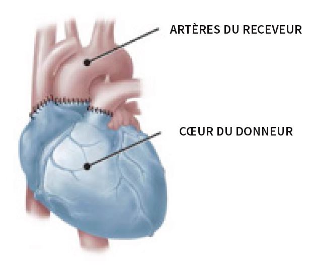 Illustration médicale montrant comment les artères du receveur et le coeur du donneur sont rattachés lors de la transplantation.