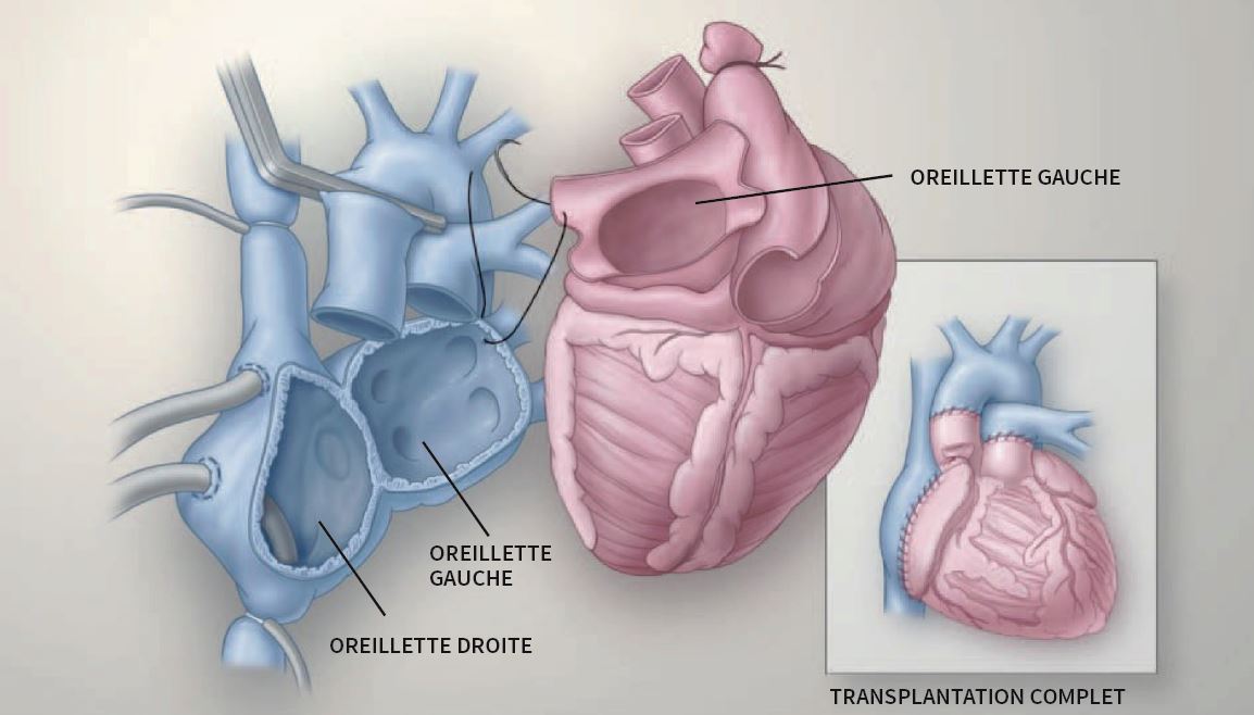 Illustration médicale montrant la connexion entre les oreillettes du patient avec le coeur du donneur dans le cadre d'une transplantation utilisant la technique bioriculaire.