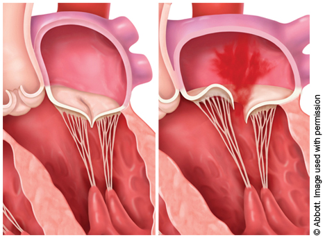 Side-by-side illustrations showing a normal and a prolapsed heart valve.