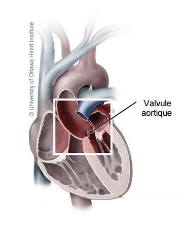 Illustration médicale d'un coeur montrant la valvule aortique rétrécie ou qui ne s'ouvre pas adéquatement, causant la sténose aortique.