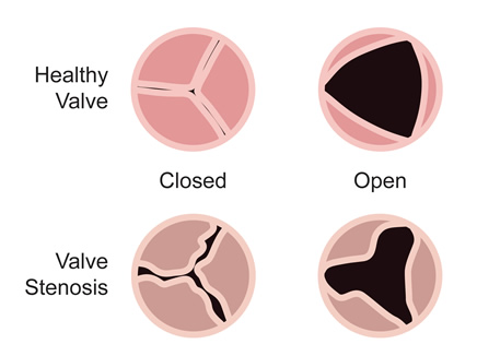 Medical illustration of a healthy aortic valve while closed and open and a valve with stenosis while closed and open.