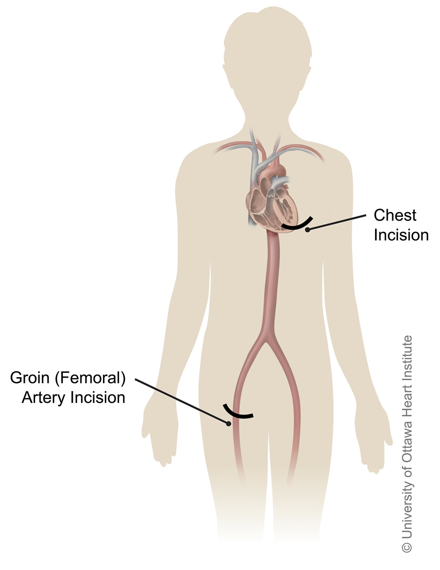 Medical illustration of a human body showing the groin and chest incision sites for transcatheter aortic valve implant surgery.