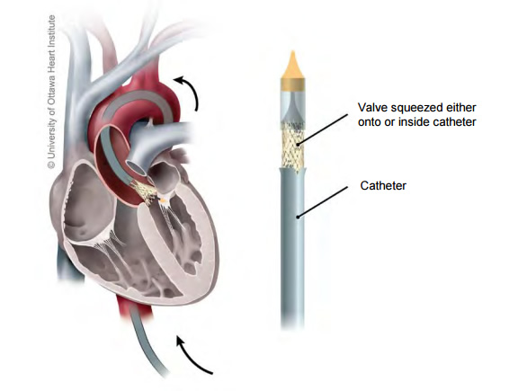 Diagram of a catheter and valve showing the path the catheter takes through the heart during the transcatheter aortic valve implant procedure.
