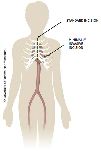 First Heart Incision Open Heart Surgery Diagram