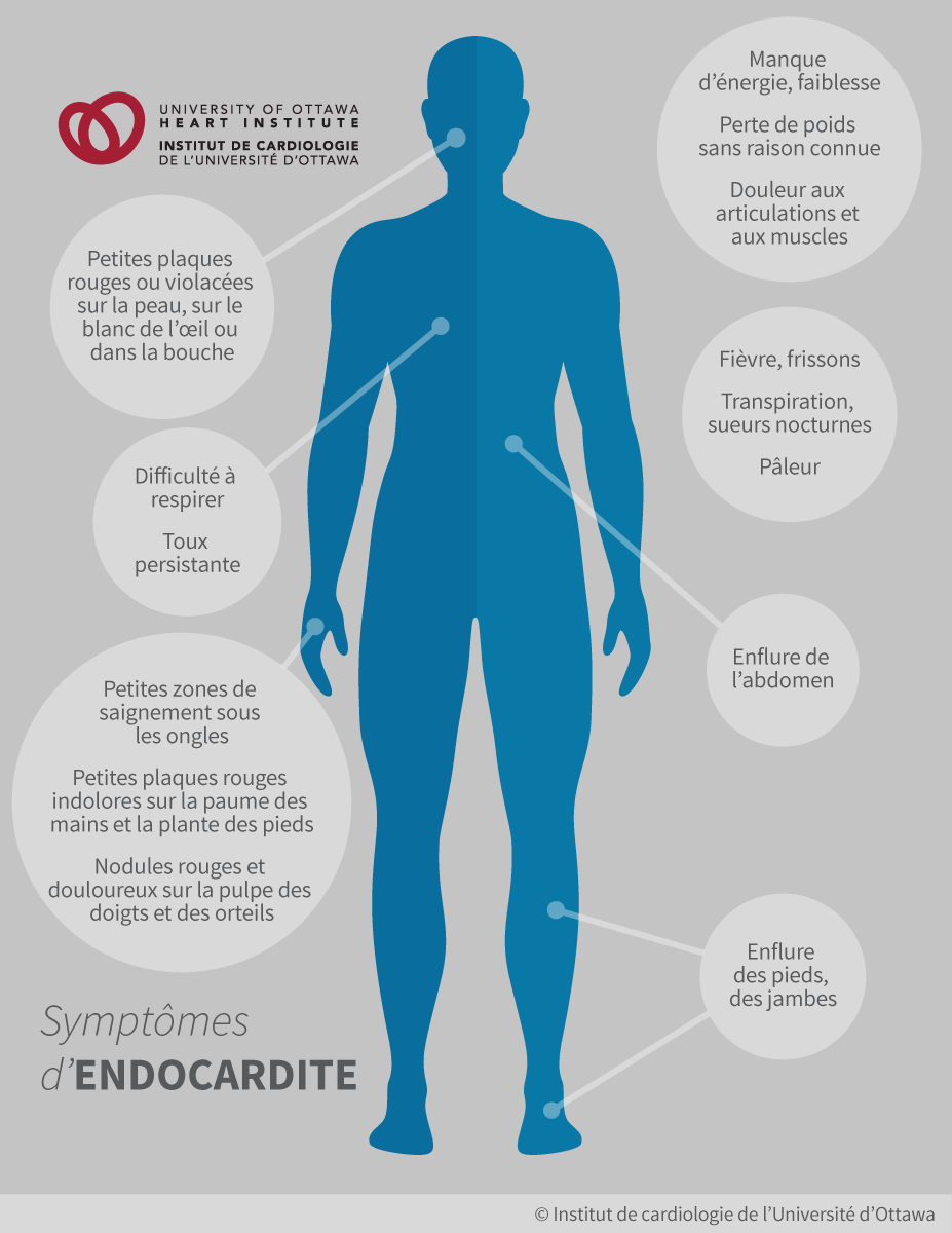 Endocardite infectieuse - symptômes, causes, traitements et prévention -  VIDAL