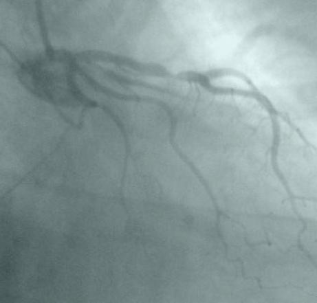 Image of an angiogram showing a blockage
