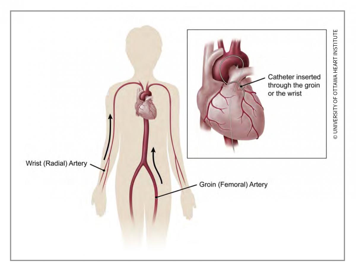 Illustration showing a thin, flexible tube called a catheter being inserted into an artery and/or vein located in the groin area (or the arm) and guided to the heart