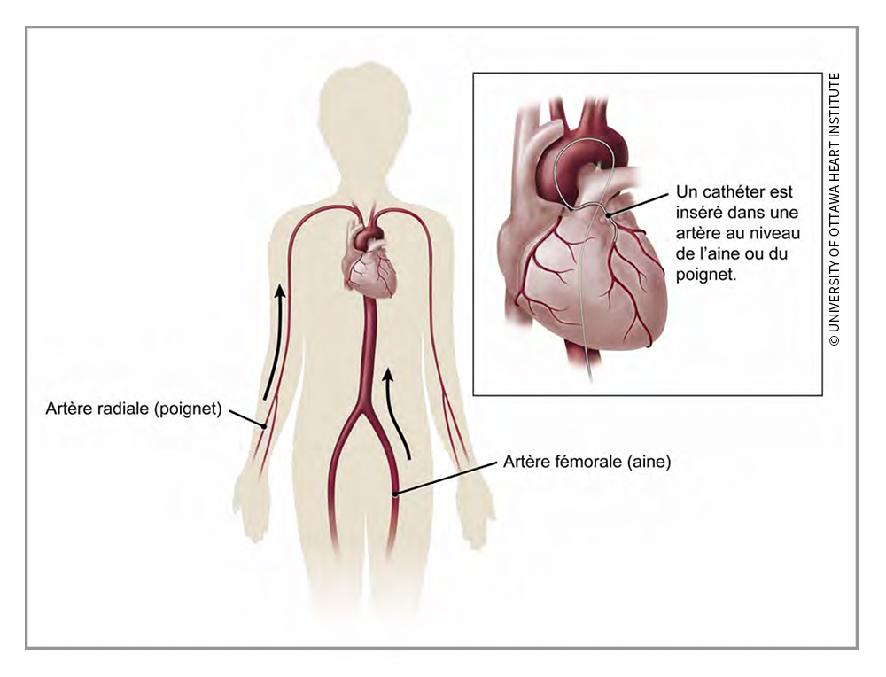 L’intervention prévoit l’insertion d’un cathéter (mince tube flexible) dans un vaisseau sanguin de la région de l’aine (fémorale) ou du bras (radiale) pour le guider jusqu’au cœur.