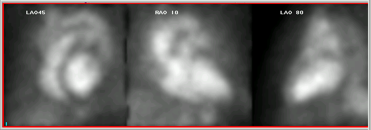 Output from a Nuclear Multigated Acquisition Scan