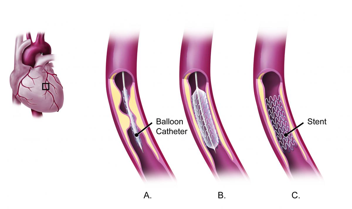 Illustration showing a thin, flexible tube called a catheter being inserted into an artery and/or vein located in the groin area (or the arm) and guided to the heart to implant a stent