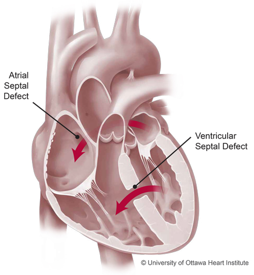 Illustration of adult congential heart defects showing Atrial Septal Defect and Ventricular Septal Defect
