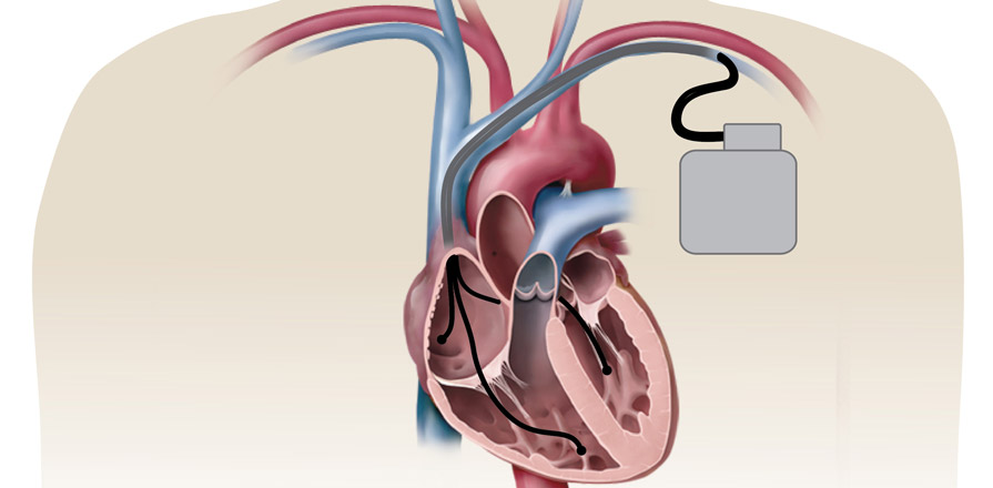 Illustration of an implantable cardioverter defibrillator (ICD)