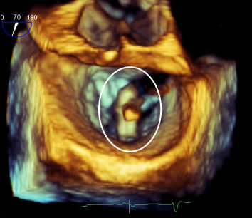 The MitraClip offers a less invasive way to repair damaged mitral valves. In this 3-D echocardiogram, the catheter has been inserted from the far side of the valve (blue area, centre) and the clip (circled) has been attached to the closed valve to create a better seal and reduce the backflow of blood.