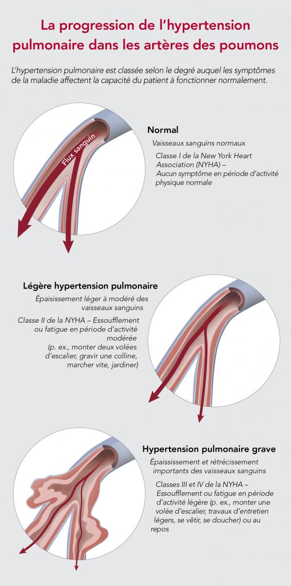 La progression de l'hypertension pulmonaire dans les arteres des poumons