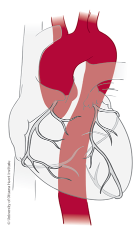 illustration de l'aorte