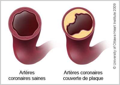 Illustration d'une artere coronaire saine et d'une artere coronaire couverte de plaque