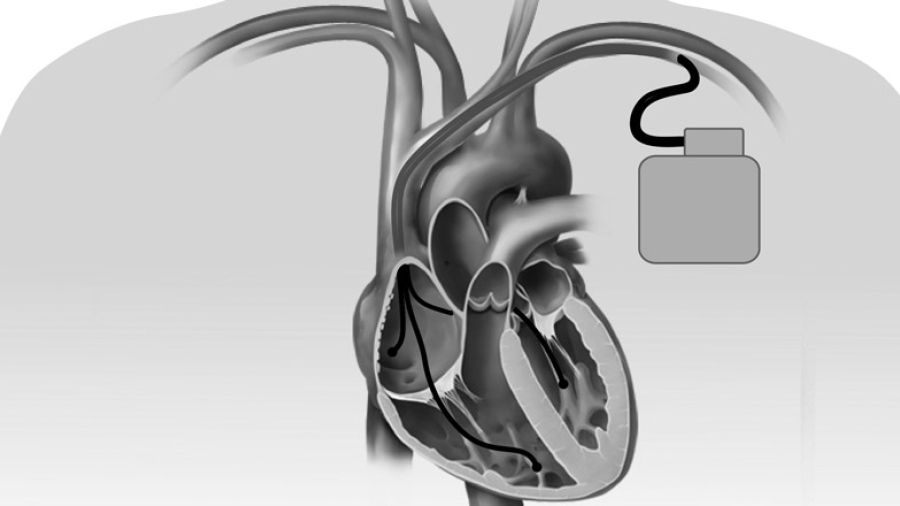 An illustration of an implantable cardioverter defibrillator (ICD)