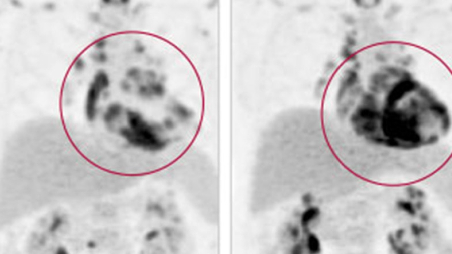 Image of cardiac sarcoidosis