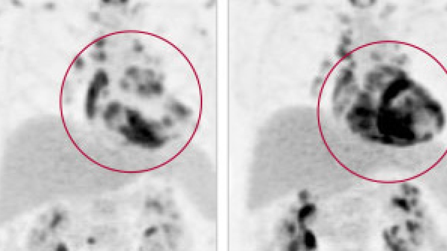PET scan of cardiac sarcoidosis