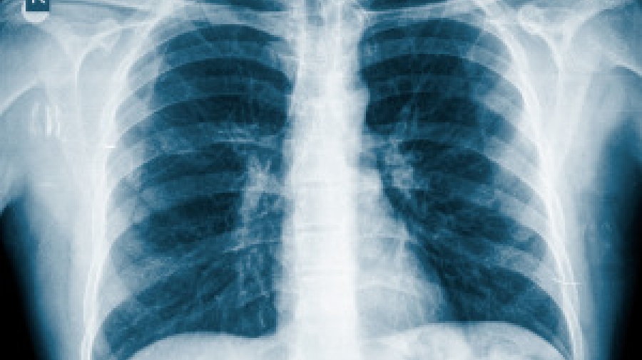 pneumonia