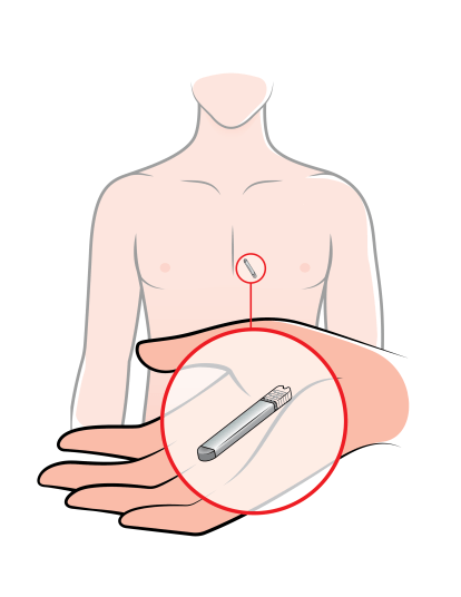 Implantable loop recorder: size and implantation site.