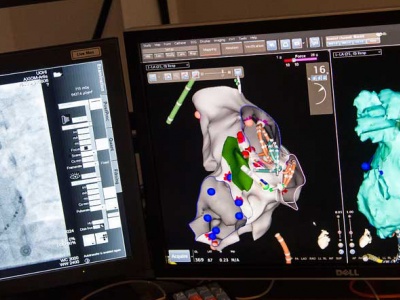 Fluoroscopy (left) provides an X-ray view of the heart and the position of the catheters. The mapping system (right) operates like a GPS system showing the location of the catheters in a three-dimensional view of the heart that can be rotated in any direction. Using this system reduces the need for fluoroscopy, cutting down on X-ray exposure for the patient.