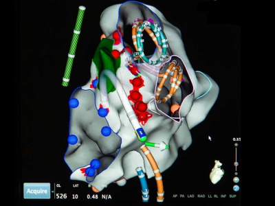 The mapping system helps the doctor track ECG measurements at various locations and allows the team to specific sites of interest. It also records locations that have been ablated (red dots) using the radiofrequency ablation catheter (white with green tip, at centre).