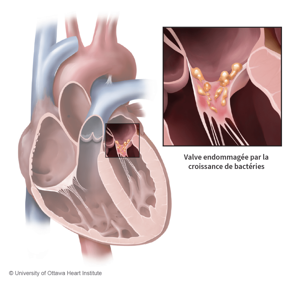 Endocardite Illustration