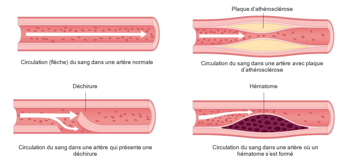 En quoi la DSAC est-elle différente d’une crise cardiaque «&nbsp;typique »?