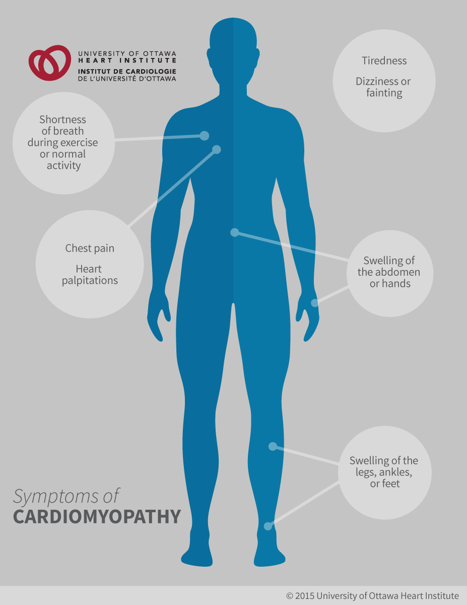 Symptoms of Cardiomyopathy: Shortness of breath, during exercise or normal activity, Dizziness or fainting, Chest pain (angina), Tiredness, Abnormal heart rhythms, Heart palpitations (a racing or irregular heartbeat); Swelling in the hands, legs, ankles, feet, or abdomen