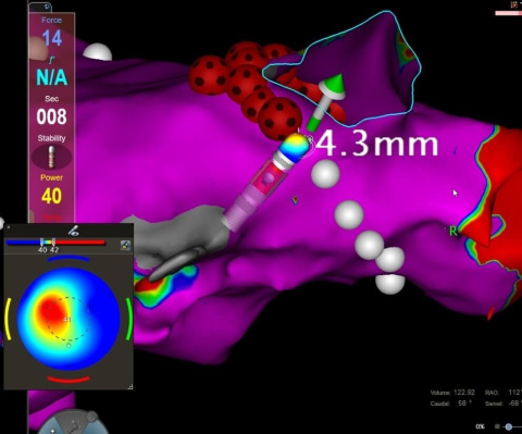 Biosense Webster’s CARTO3® 3D electroanatomic mapping system guides an atrial fibrillation ablation procedure using NGEN® ablation generation technology and the new QDOT MICRO® ablation catheter. In QMODE+, spotted tags indicate ablations completed using high-power, short duration ablations (90W of power applied for four seconds). The catheter displays the temperature of the patient’s heart tissue on a monitor in real-time.