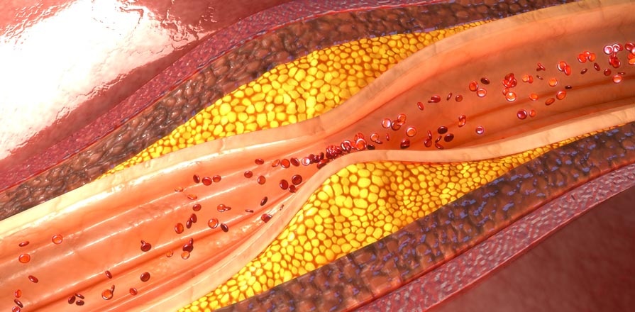 Magnified viewed of a narrowed artery