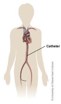 Illustration showing the path of the MitraClip catheter from the groin to the heart.