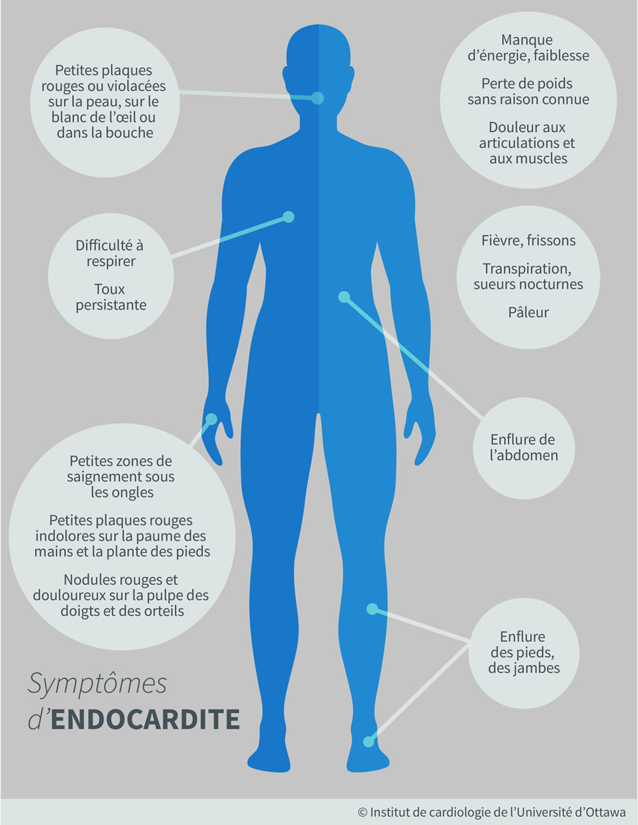 Endocardite - Causes, Symptmes, Diagnostic. - Cano Sant