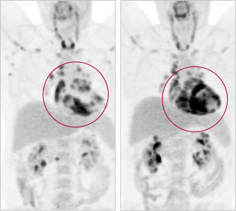 PET scan showing the progress of cardiac sarcoidosis